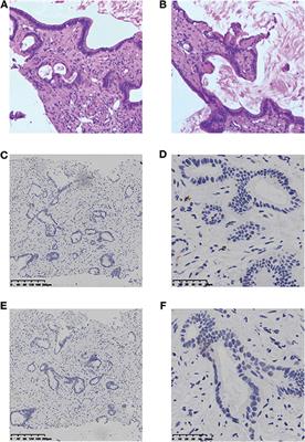 Anti-PD-1 Immunotherapy and Radiotherapy for Stage IV Intrahepatic Cholangiocarcinoma: A Case Report